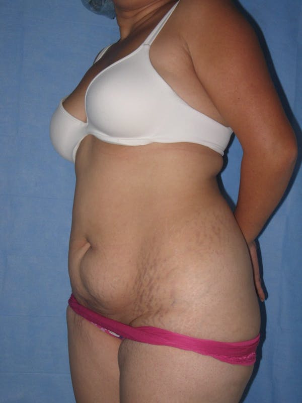 Tummy Tuck (Abdominoplasty) Before & After Gallery - Patient 13574694 - Image 3