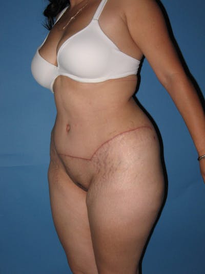 Tummy Tuck (Abdominoplasty) Gallery - Patient 13574694 - Image 4