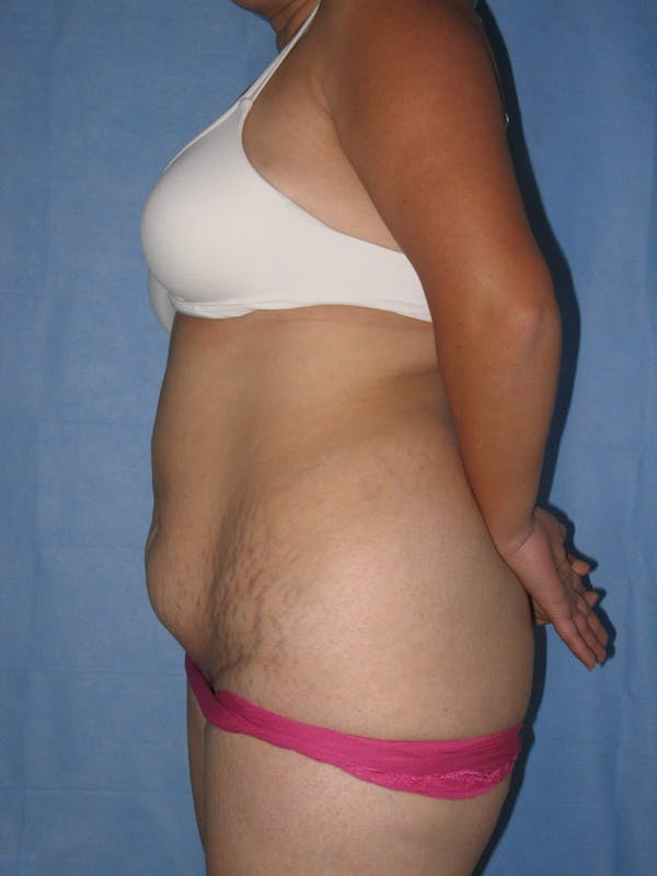 Tummy Tuck (Abdominoplasty) Before & After Gallery - Patient 13574694 - Image 5