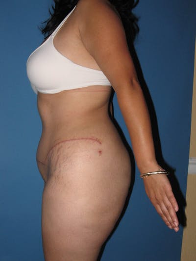 Tummy Tuck (Abdominoplasty) Before & After Gallery - Patient 13574694 - Image 6