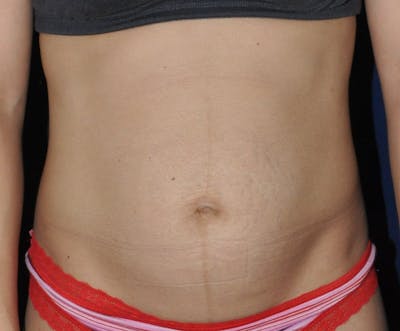 Tummy Tuck (Abdominoplasty) Before & After Gallery - Patient 13574696 - Image 1