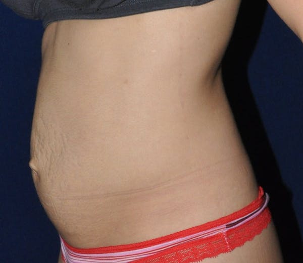 Tummy Tuck (Abdominoplasty) Before & After Gallery - Patient 13574696 - Image 3