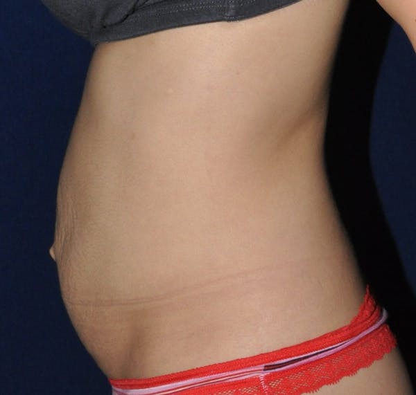 Tummy Tuck (Abdominoplasty) Before & After Gallery - Patient 13574696 - Image 5