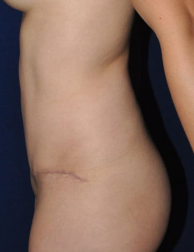 Tummy Tuck (Abdominoplasty) Before & After Gallery - Patient 13574696 - Image 6
