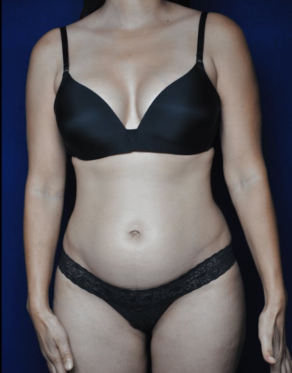 Tummy Tuck (Abdominoplasty) Before & After Gallery - Patient 13574697 - Image 1