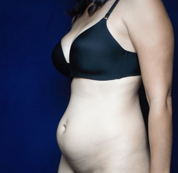 Tummy Tuck (Abdominoplasty) Before & After Gallery - Patient 13574697 - Image 3