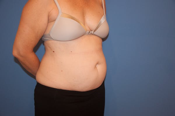 Tummy Tuck (Abdominoplasty) Before & After Gallery - Patient 13574698 - Image 1