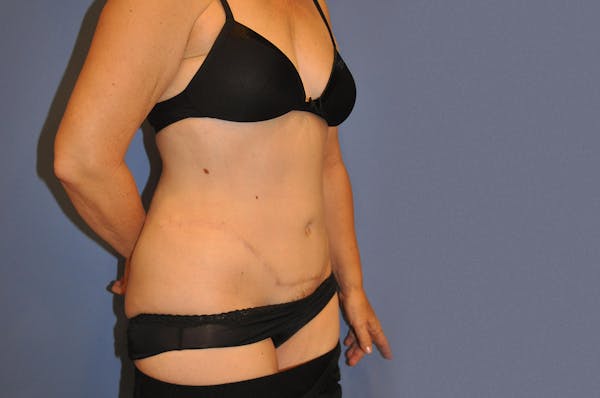 Tummy Tuck (Abdominoplasty) Before & After Gallery - Patient 13574698 - Image 2