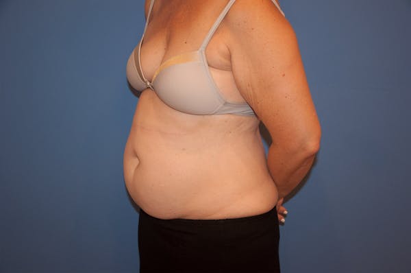 Tummy Tuck (Abdominoplasty) Before & After Gallery - Patient 13574698 - Image 3