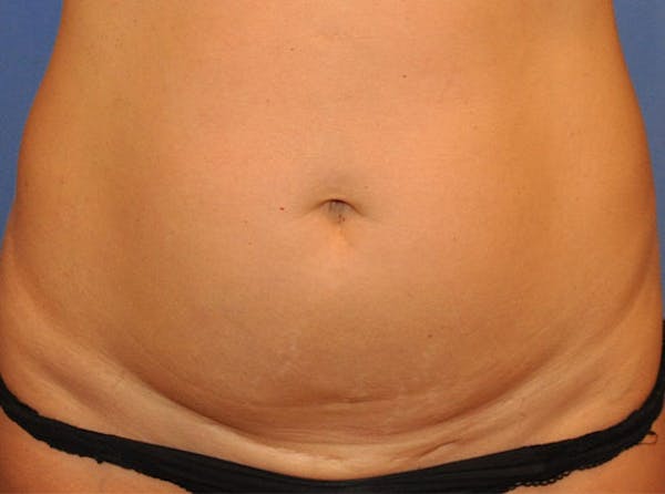 Tummy Tuck (Abdominoplasty) Gallery - Patient 13574699 - Image 1