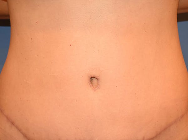 Tummy Tuck (Abdominoplasty) Before & After Gallery - Patient 13574699 - Image 2