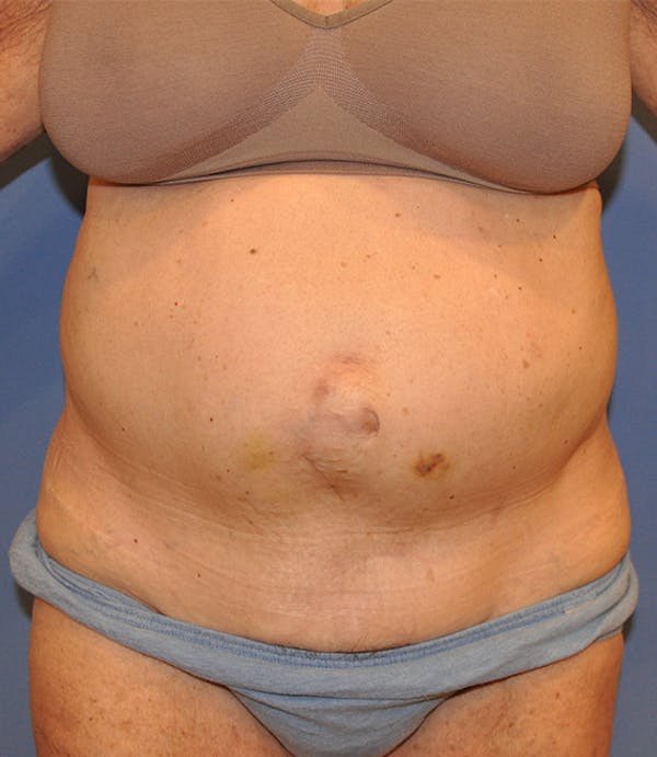 Tummy Tuck (Abdominoplasty) Before & After Gallery - Patient 13574700 - Image 1