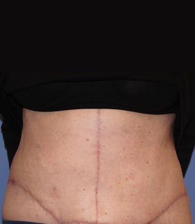 Tummy Tuck (Abdominoplasty) Before & After Gallery - Patient 13574700 - Image 2
