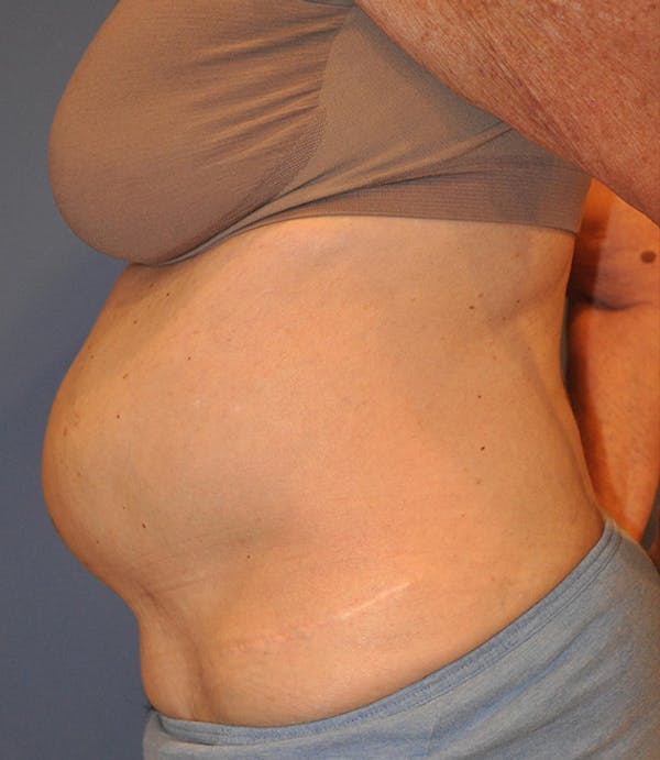 Tummy Tuck (Abdominoplasty) Before & After Gallery - Patient 13574700 - Image 3