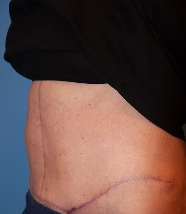 Tummy Tuck (Abdominoplasty) Before & After Gallery - Patient 13574700 - Image 4