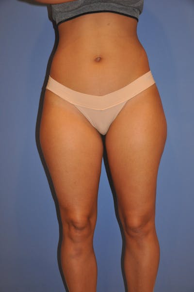 Liposuction Before & After Gallery - Patient 13574701 - Image 1