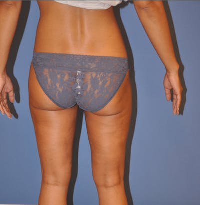 Liposuction Before & After Gallery - Patient 13574701 - Image 4