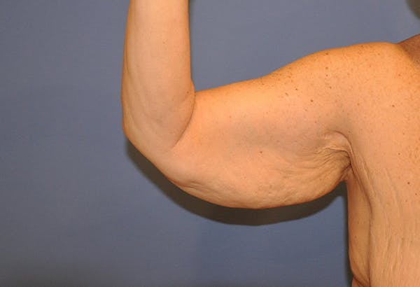 Brachioplasty (Arm Lift) Before & After Gallery - Patient 13574716 - Image 1