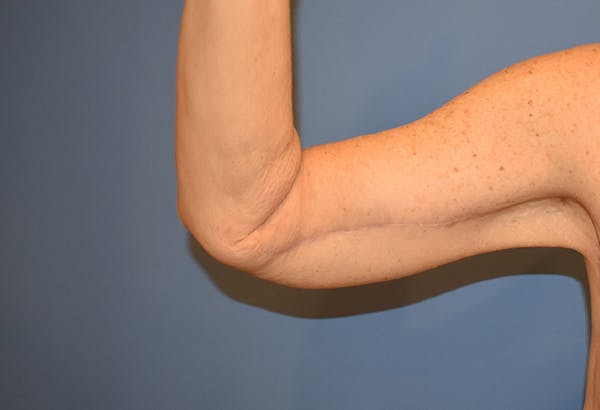 Brachioplasty (Arm Lift) Before & After Gallery - Patient 13574716 - Image 2