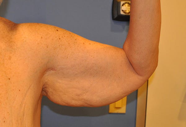 Brachioplasty (Arm Lift) Before & After Gallery - Patient 13574716 - Image 3