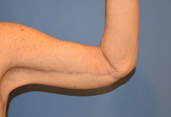Brachioplasty (Arm Lift) Before & After Gallery - Patient 13574716 - Image 4