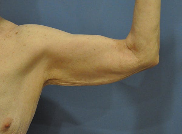 Brachioplasty (Arm Lift) Before & After Gallery - Patient 13574718 - Image 1