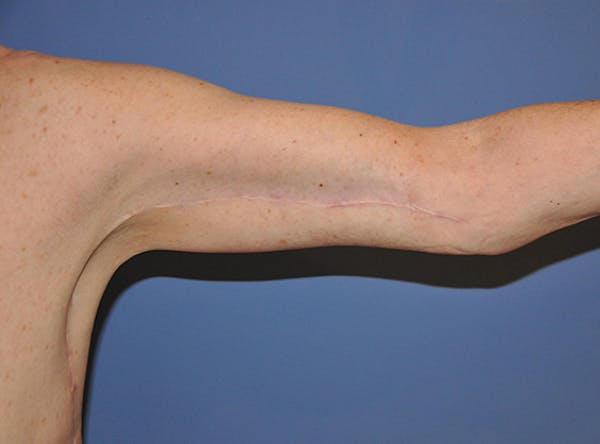 Brachioplasty (Arm Lift) Before & After Gallery - Patient 13574718 - Image 2