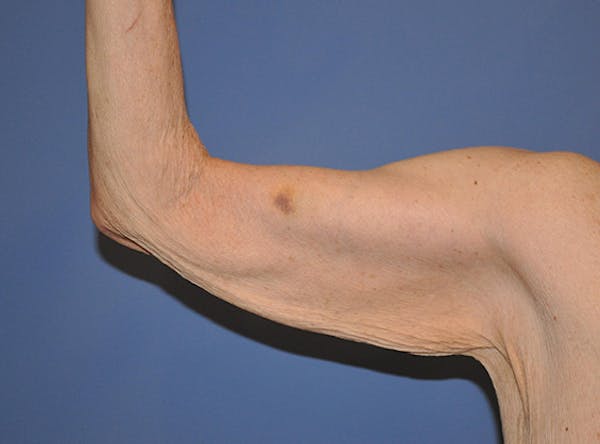 Brachioplasty (Arm Lift) Before & After Gallery - Patient 13574718 - Image 3