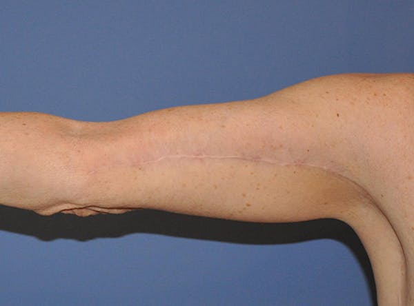 Brachioplasty (Arm Lift) Before & After Gallery - Patient 13574718 - Image 4