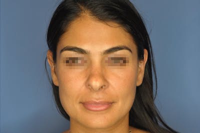 Rhinoplasty Before & After Gallery - Patient 13574730 - Image 1