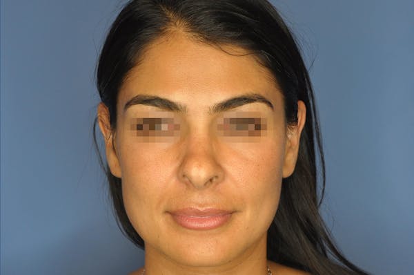 Rhinoplasty Before & After Gallery - Patient 13574730 - Image 1