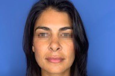 Rhinoplasty Before & After Gallery - Patient 13574730 - Image 2
