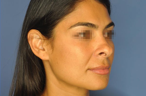 Rhinoplasty Before & After Gallery - Patient 13574730 - Image 3