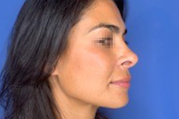 Rhinoplasty Before & After Gallery - Patient 13574730 - Image 4