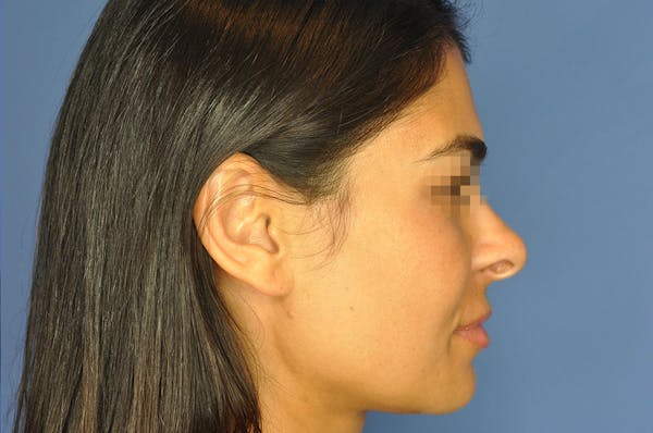 Rhinoplasty Before & After Gallery - Patient 13574730 - Image 5