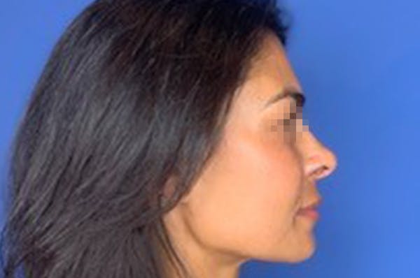 Rhinoplasty Before & After Gallery - Patient 13574730 - Image 6