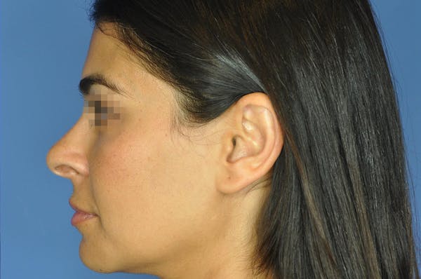 Rhinoplasty Before & After Gallery - Patient 13574730 - Image 7