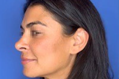 Rhinoplasty Before & After Gallery - Patient 13574730 - Image 8