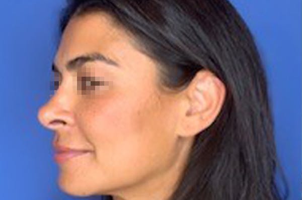 Rhinoplasty Before & After Gallery - Patient 13574730 - Image 8
