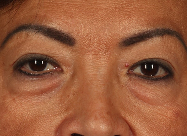 Dr. Wirth Eyelid Surgery Before & After Photo in Newport Beach