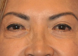 Dr. Wirth Eyelid Surgery Before & After Photo in Newport Beach