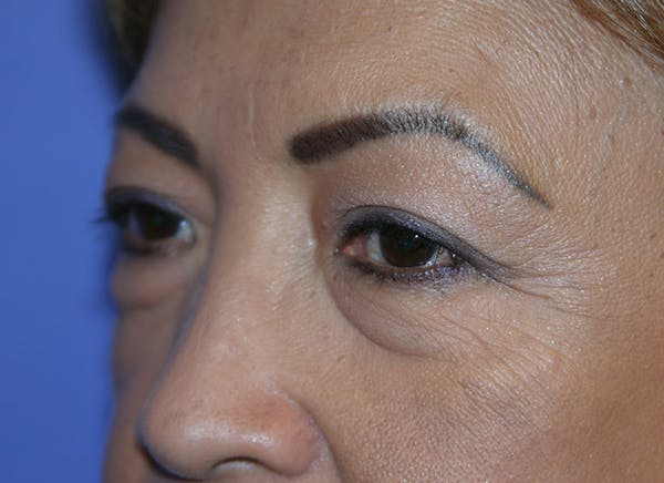 Blepharoplasty (Eyelid Surgery) Before & After Gallery - Patient 13574740 - Image 3