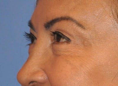Blepharoplasty (Eyelid Surgery) Before & After Gallery - Patient 13574740 - Image 4