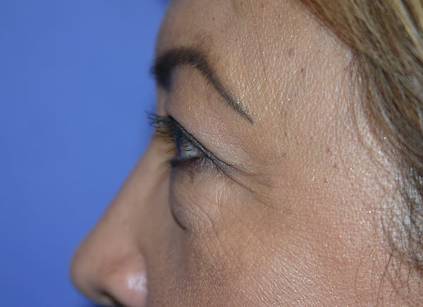 Blepharoplasty (Eyelid Surgery) Before & After Gallery - Patient 13574740 - Image 5