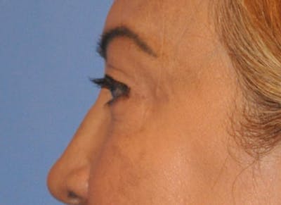 Blepharoplasty (Eyelid Surgery) Before & After Gallery - Patient 13574740 - Image 6