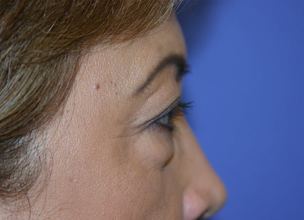 Blepharoplasty (Eyelid Surgery) Before & After Gallery - Patient 13574740 - Image 7