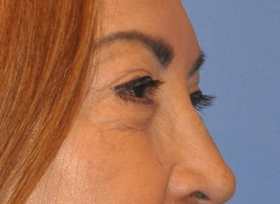 Blepharoplasty (Eyelid Surgery) Gallery - Patient 13574740 - Image 8