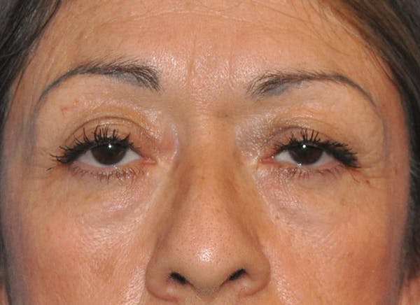 Blepharoplasty (Eyelid Surgery) Before & After Gallery - Patient 13574741 - Image 1