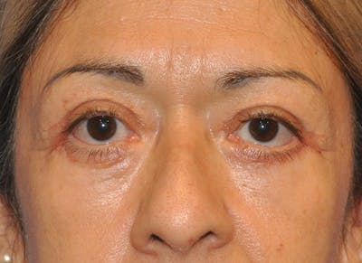 Blepharoplasty (Eyelid Surgery) Gallery - Patient 13574741 - Image 2
