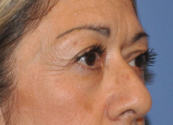 Blepharoplasty (Eyelid Surgery) Before & After Gallery - Patient 13574741 - Image 3